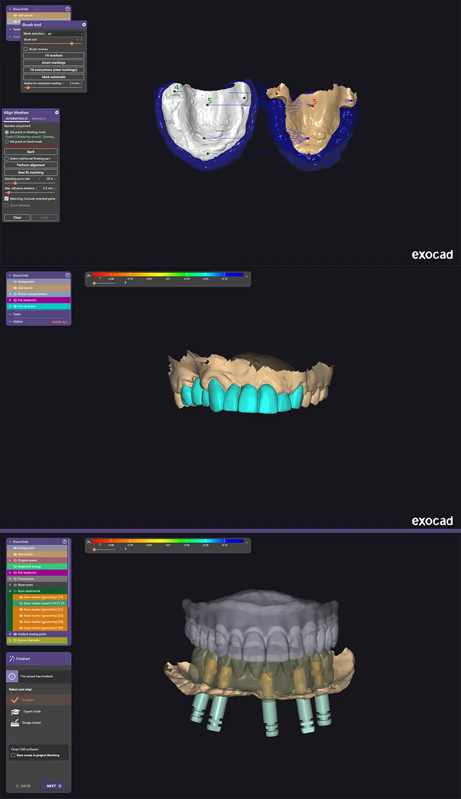 Exocad full-arch prosthetic design in progress